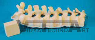 Spine section, burst fracture